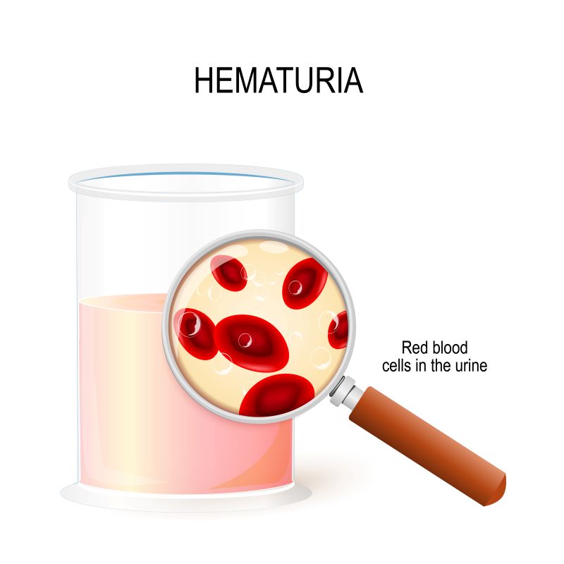 hematuria diagram showing blood cells in urine