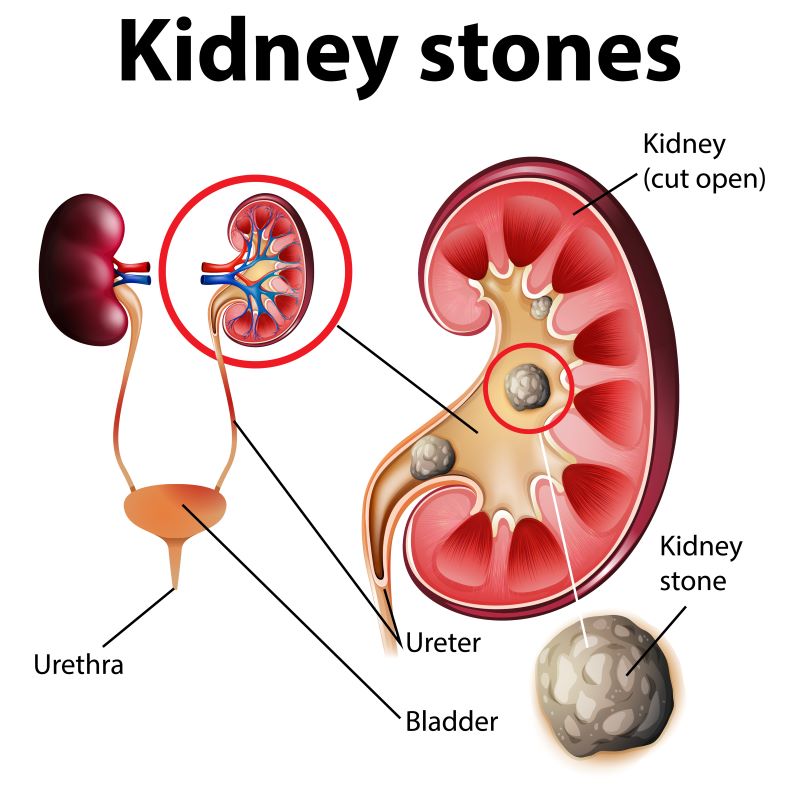 diagram of kidney stones